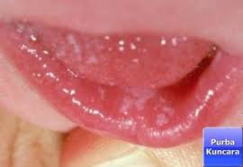 Lidah putih pada bayi merupakan peningkatan jamur, jamur ini memang pada dasarnya hidup didalam mulut dan tidak. Bintik Bintik Di Bibir
