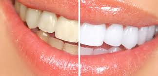 Çeşitli kaynaklardan sizler için diş taşı nasıl temizlenir doğal yollarla sorusuna derlediğimiz farklı alternatif çözüm önerileri, kurtulmak için denemediğiniz diş dr. Dis Tasi Nasil Gecer Iste Dis Taslarini Temizleyen Mucizevi Yontem Galeri Takvim