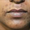 While most people think of 'laser' and 'hair removal' in the same sentence, laser treatments are also a very popular method of skin rejuvenation, particularly for the treatment of pigmentation.it is a fast, effective and relatively comfortable treatment which can be performed within your lunch break. 1