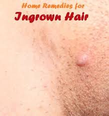 It is possible for anyone to get an ingrown hair. Ingrown Hair Is Generally Known As Razor Bumps That Have The Strength To Grow Back Into The Skin Inst Ingrown Hair Remedies Ingrown Hair Ingrown Hair Treatment