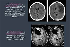 Tipos de isquemia o derrame cerebral. Diferencias Entre Derrame E Infarto Cerebral