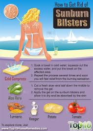 How To Get Rid Of Sunburn Blisters Top 10 Home Remedies Sunburn Blisters Heal Sunburn Get Rid Of Sunburn
