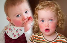 kizarik yanakli bebeklerde dikkat tokatlanmis yanak sendromu ve belirtileri cocuk haberleri