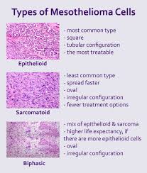 Peritoneal mesothelioma, which forms in the lining of the abdominal cavity (peritoneum) Pacific Heart Lung Blood Institute Mesothelioma Cells Infographic Copy