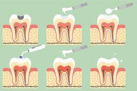 How much to get a cavity filled. Dental Fillings Procedure Costs Smile Com Au