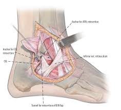 The calcaneofibular ligament is a narrow, rounded cord, running from the tip of the lateral malleolus of the fibula downward and slightly backward to a tubercle on the lateral surface of the calcaneus. Figure 4 Lateral Collateral Ligament Repair Springerlink