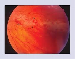 Image result for HIV Retinitis
