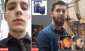 Home beard care beard care tips stimulate beard growth with minoxidil: British Men Using A Hair Loss Drug Off Label To Grow Full Beards Daily Mail Online