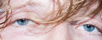 Es muy importante tener en cuenta que los hongos de la piel deben ser tratados por un médico o dermatólogo. Asi Se Ven Tus Ojos Cuando Estas Drogado