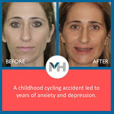 PATIENT TESTIMONIAL Gina broke her jaw during a childhood cycling accident.  The injury caused her jaw to grow at an angle leaving her with a protruding  jaw and unable to bite properly.