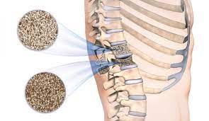 Sessiz bir hastalık olan osteoporoz da hastalar çoğunlukla sırt, bel ağrıları gibi şikayetlerle doktora başvururlar. Kemik Erimesi Osteoporoz Nedir Kemik Erimesi Belirtileri Nelerdir Ve Tedavisi Var Midir Saglik Haberleri