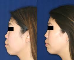 Nose job surgery in the world ranked first in all plastic surgery. Permanent Non Surgical Nose Job The Little Known No Knife Procedure
