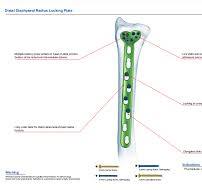 Distal Diaphyseal Radius Locking Plate,Medical Device ...