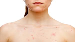 We did not find results for: Sekundaer Syfilis Symptomer Og Tegn Behandling