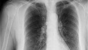 The main symptoms of lung cancer include Smokers With Clear Lungs Still Have Cancer Signs Clinical Advisor