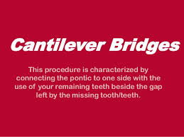 This type of bridge might be used when there is only one natural tooth next to a missing tooth. Dental Bridges Defined