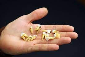 How do you take out a loose tooth? I Couldn T Afford Private Dentist So I Used Pliers To Pull Out 13 Top Teeth Mirror Online