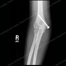 It is larger and more prominent than the lateral epicondyle and is directed slightly more posteriorly in the anatomical position. Elbow Fractures In Children An Overview Hss Edu