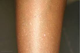 Skincare Helle Flecken Auf Der Haut Was Ist Das Konsumkaiser