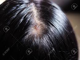 Please note there are quite a few sunflower seeds in the bed as there is a bird feeder above it. Close Up Of Black Hair Of Asians With Hair And Mold Health Problems Stock Photo Picture And Royalty Free Image Image 131291960