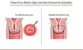 Tanda tanda awal kanser payudara. Rahim Agzi Kanseri Belirtileri Ve Tedavisi