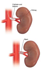 Renal artery stenosis, renal vascular hypertension and ischemicnephropathy. Renal Angioplasty And Stenting Saint Luke S Health System