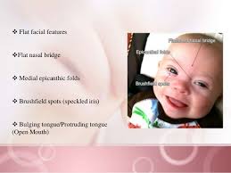 He has epicanthic folds and a low nasal bridge and an up turned nose, now i've googled away and it says genetic disorders etc, just wondering if any other mummas los have these features to make me feel better attacked a photo of what a low nasal bridge is xx. Down Syndrome Features Nengu