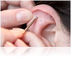 Annas News Ear Acupressure Enhances Ivf Cycle Outcome
