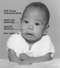 For some people quitting smoking was never an option until they discovered vaping. Fetal Alcohol Spectrum Disorder Wikipedia
