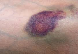 Oct 06, 2016 · hot water bottle. Do You Bruise Easily When To Get It Checked Out Health Essentials From Cleveland Clinic