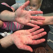Outbreaks of the disease are more common. Hand Foot And Mouth Disease The Illness From Hell Yummymummyclub Ca
