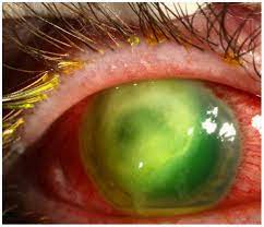 Visual Loss After Contact Lens Related Pseudomonas Keratitis The University Of Iowa Ophthalmology