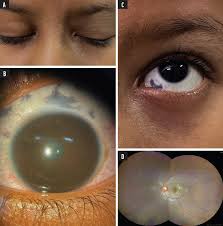 Image result for nevus sclerae