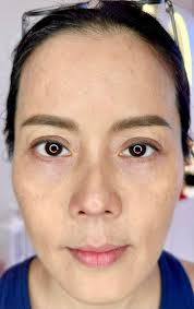 Hi,i want to ask you,about plasma pen fibrolast ,my client have a normal  faces,but she didn't even erase the wrinkles, she got a little pigmented  because she didn't use spf. Should I