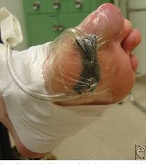 Maybe you would like to learn more about one of these? Pdf A Prospective Study Of Negative Pressure Wound Therapy With Integrated Irrigation For The Treatment Of Diabetic Foot Ulcers Semantic Scholar