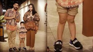 Menjadi lebih rentan terhadap infeksi, termasuk pada sistem. Bentuk Kaki Anak Raffi Ahmad Gigi Diduga Tak Normal Sebab Kaki X Dan Cara Atasinya
