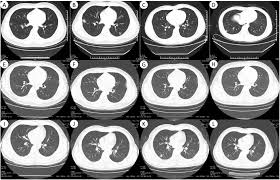 Rapid Asymptomatic Transmission Of Covid 19 During The Incubation Period Demonstrating Strong Infectivity In A Cluster Of Youngsters Aged 16 23 Years Outside Wuhan And Characteristics Of Young Patients With Covid 19 A Prospective Contact Tracing