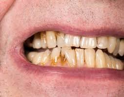 Image result for Tooth Discoloration