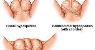 تشوهات و عيوب العضو الذكري عند الأطفال