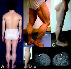 Image result for Lipodystrophy