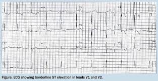 Image result for ST Elevation