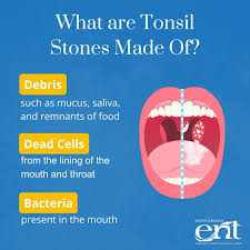 Image result for Tonsillolith