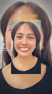 “Transformation complete! 🎉 Our patient is officially braces-free and  rocking her signature smile! #BracesOff #SignatureSmileJourney  #orthodontics #orthodontist #orthodonticspecialist #orthomaster ...