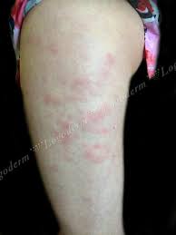 Что такое узловая эритема и как ее лечить? Uzlovataya Eritema Diagnostika Foto Lechenie