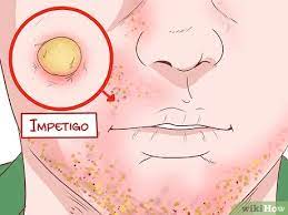 Sie sind resistent, das heißt unempfindlich, gegen häufig eingesetzte antibiotika. Symptome Einer Mrsa Infektion Erkennen 13 Schritte Mit Bildern Wikihow