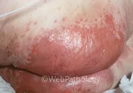 Image result for Candidiasis