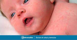 Roseola O Exantema Subito Que Es Y Causas Bebes Y Ninos