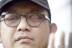 Serangan dengan air keras terhadap penyidik kpk, novel baswedan pada april lalu, terekam kamera pemantau. Novel Baswedan Conveys Bad News Archyde