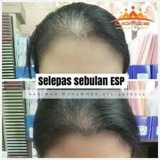 Rambut gugur selepas bersalin adalah perkara biasa yang dihadapi oleh kebanyakan wanita. Cara Menghilangkan Rambut Gugur Teruk Selepas Bersalin