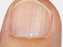 Maybe you would like to learn more about one of these? Ridges In Fingernails Types Causes And Treatment